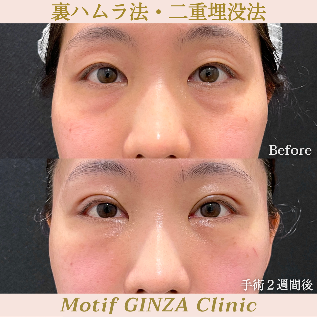 裏ハムラ法・二重埋没法（手術１ヶ月）の写真3