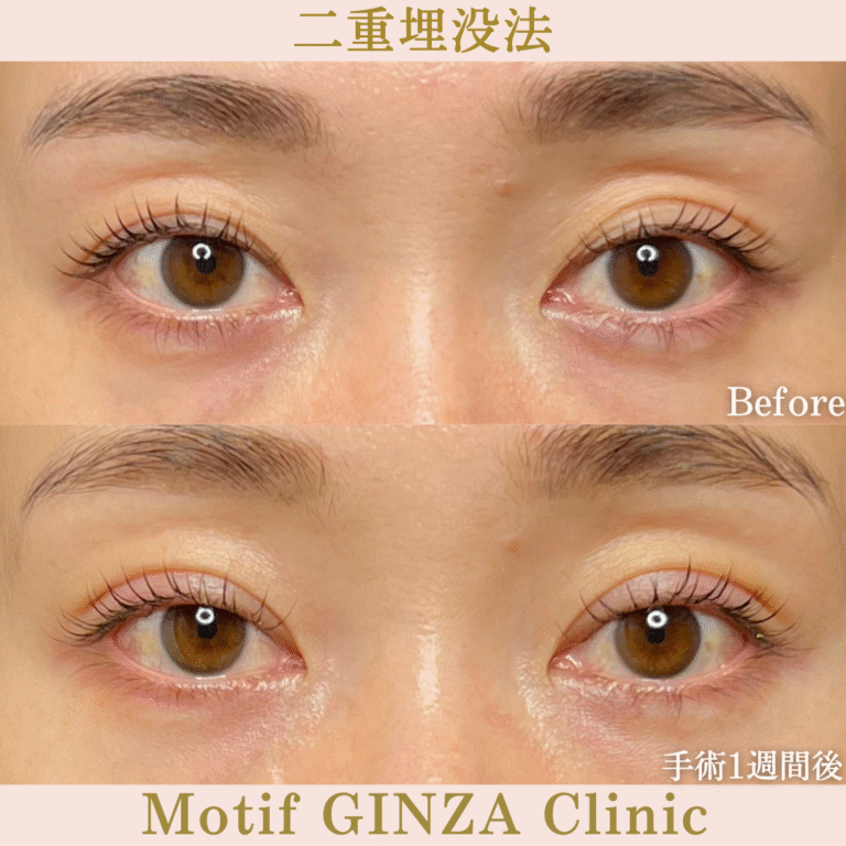 二重埋没法（手術１か月）の写真2