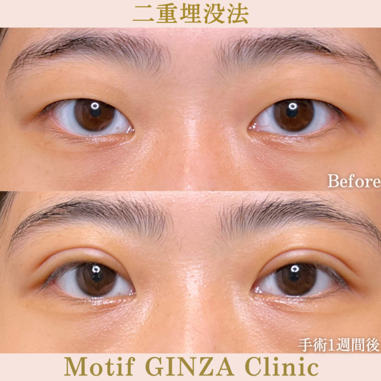 二重埋没法（手術１か月）の写真2