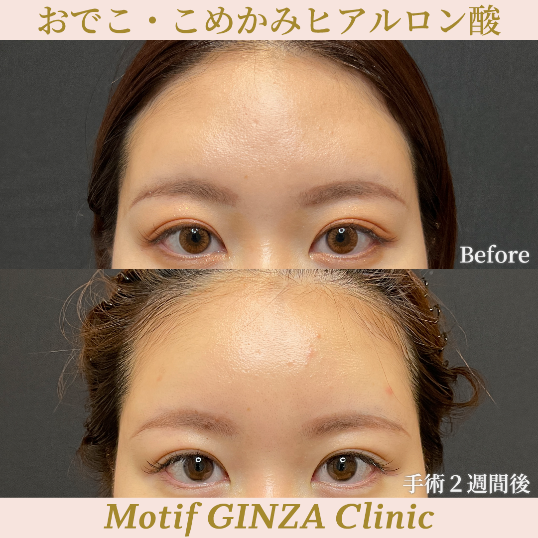 額・こめかみヒアルロン酸（手術２週間）の写真2