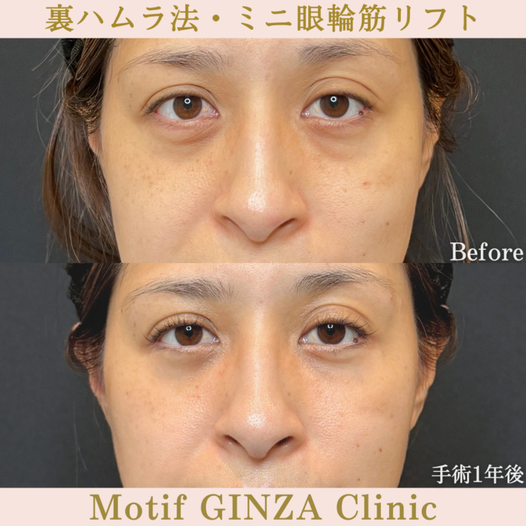裏ハムラ法・ミニ眼輪筋リフト（手術1年）