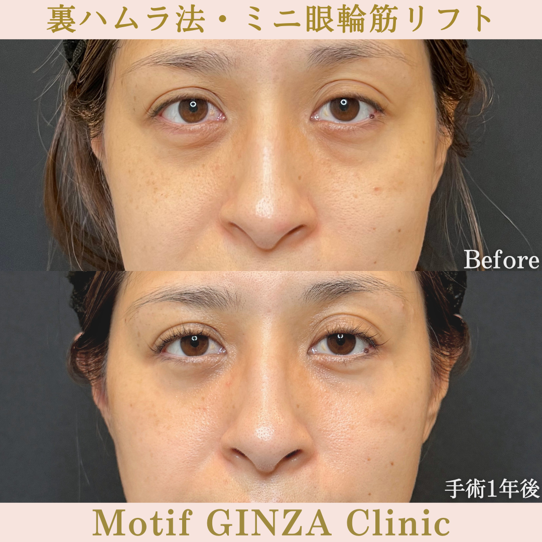 裏ハムラ法・ミニ眼輪筋リフト（手術1年）の写真