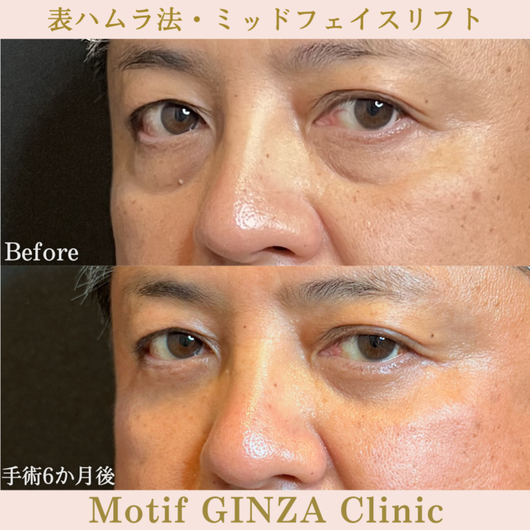 表ハムラ法・ミッドフェイスリフト（手術6か月）の写真2