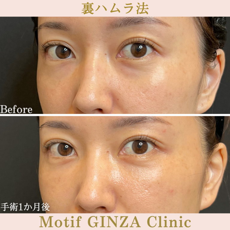 裏ハムラ法（手術3か月）の写真4