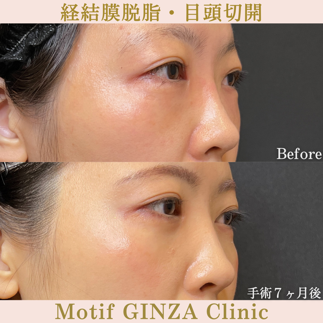 経結膜脱脂・目頭切開（手術７ヶ月）の写真2