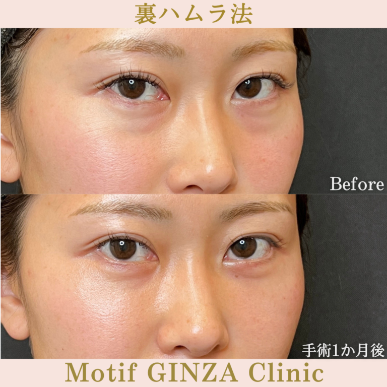 裏ハムラ法（手術１か月）の写真3