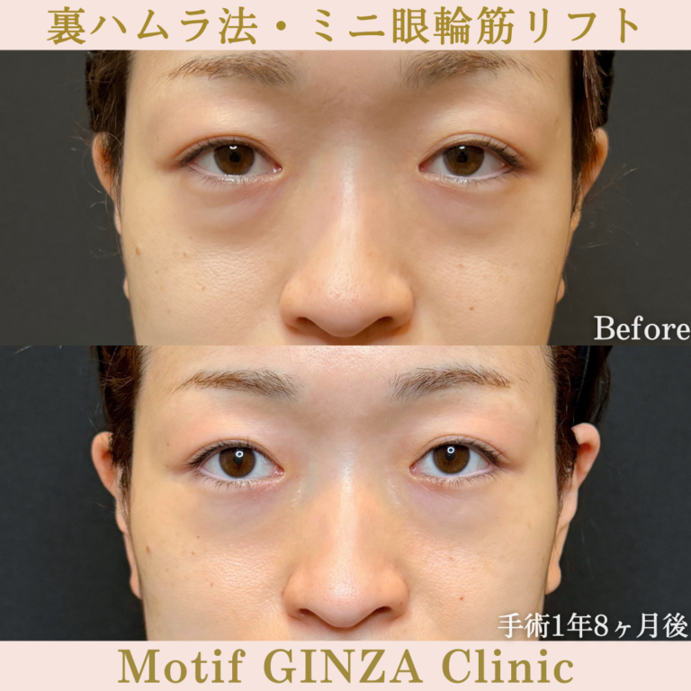 裏ハムラ法・ミニ眼輪筋リフト（手術1年8か月）