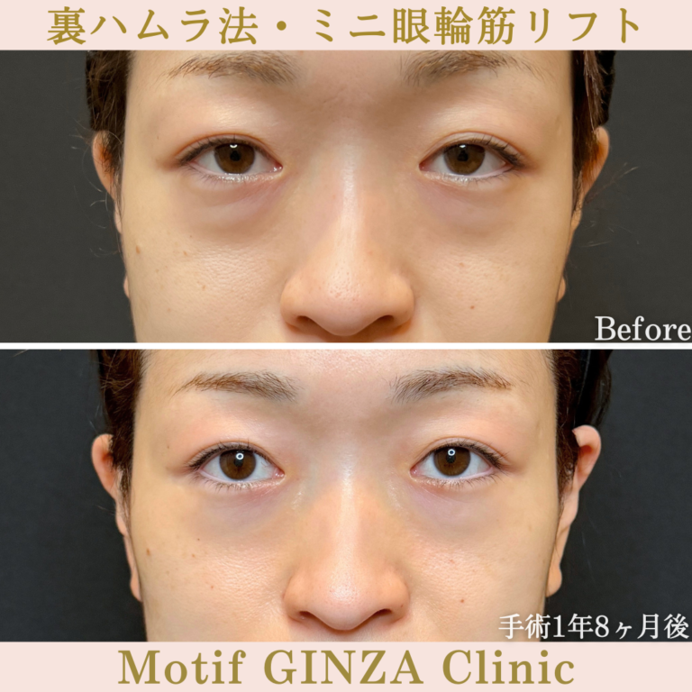裏ハムラ法・ミニ眼輪筋リフト（手術1年8か月）