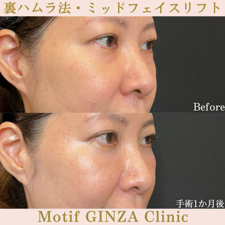 裏ハムラ法・ミッドフェイスリフト（手術３か月）の写真4