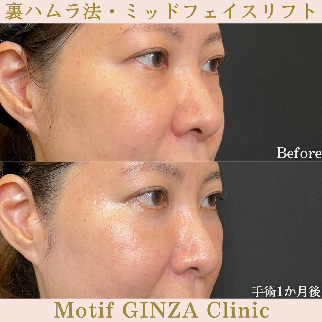 裏ハムラ法・ミッドフェイスリフト(手術6か月)の写真6