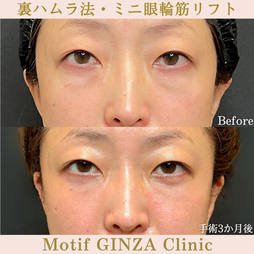 裏ハムラ法・ミニ眼輪筋リフト（手術3か月）の写真
