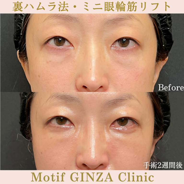 裏ハムラ法・ミニ眼輪筋リフト(手術1か月)の写真3