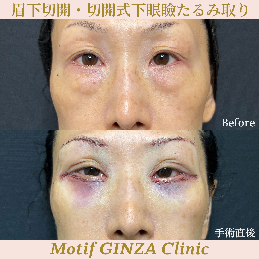 眉下切開・切開式下眼瞼たるみ取り(手術3ヶ月)の写真6