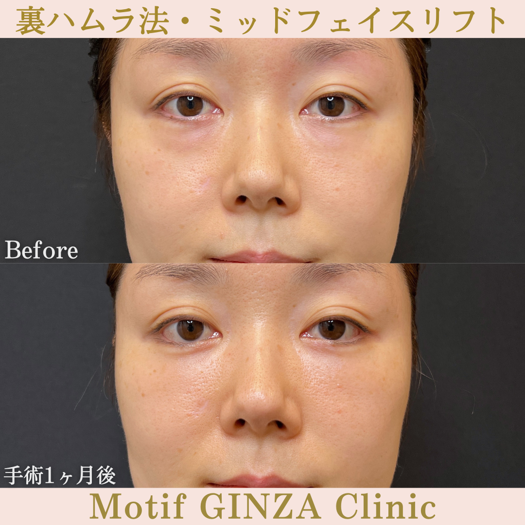 裏ハムラ法・ミッドフェイスリフト（手術１ヶ月）の写真
