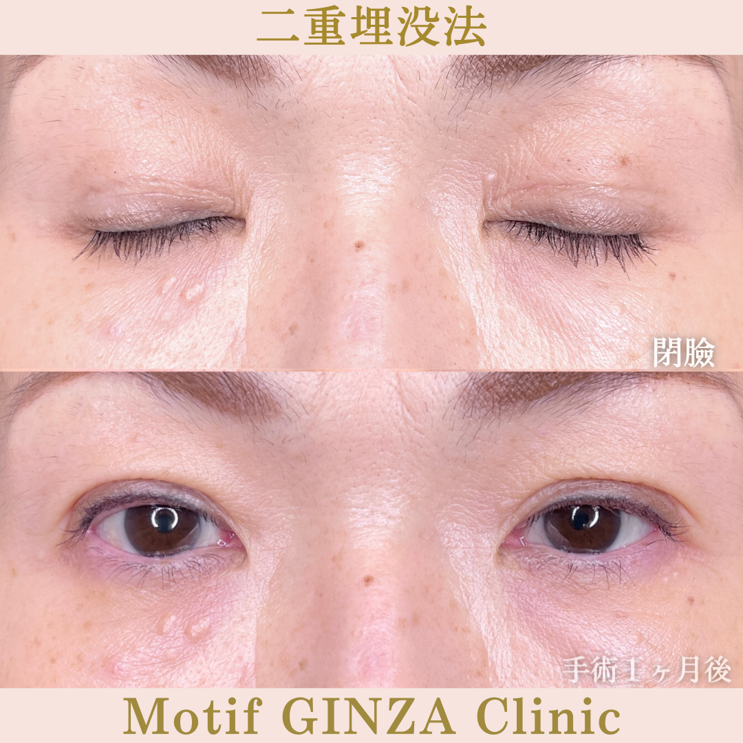 二重埋没法（手術１ヶ月）の写真2