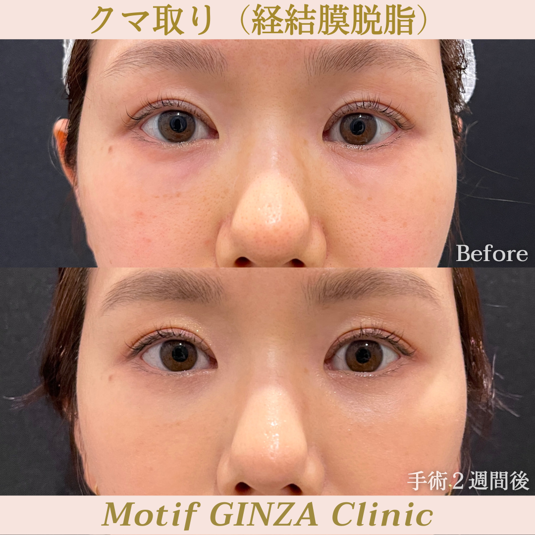 経結膜脱脂(手術1ヶ月)の写真3