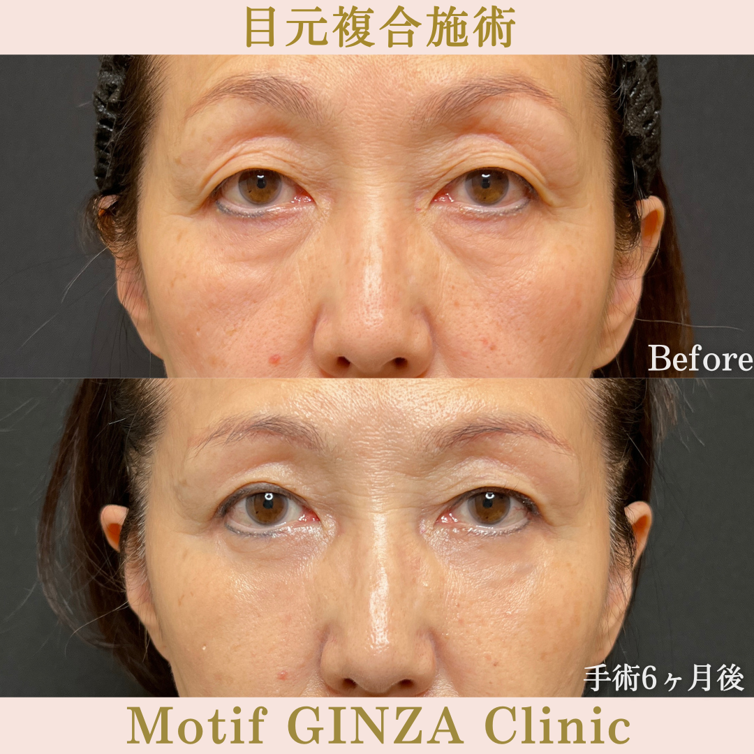 目元複合手術（手術６ヶ月）の写真