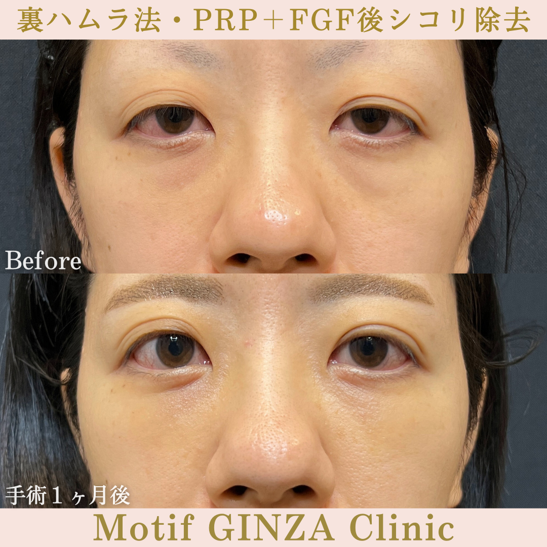 裏ハムラ法・PRP+FGF後シコリ除去(手術3ヶ月)の写真3