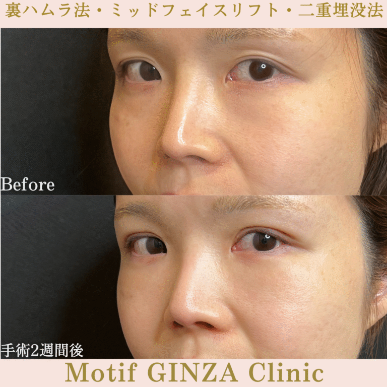 裏ハムラ法・ミッドフェイスリフト・二重埋没法（手術３か月）の写真6