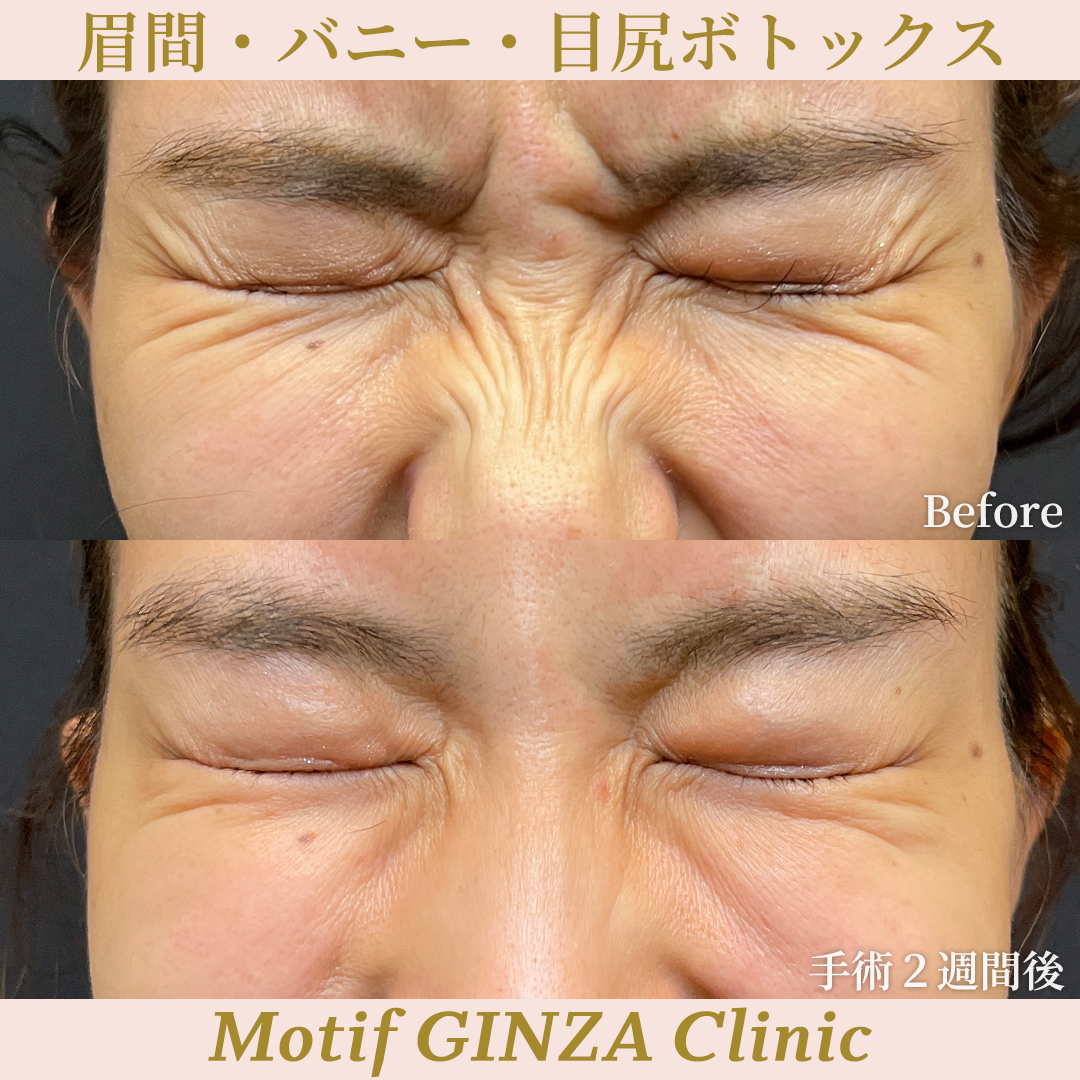 眉間・バニー・目尻ボトックス（手術２週間）の写真