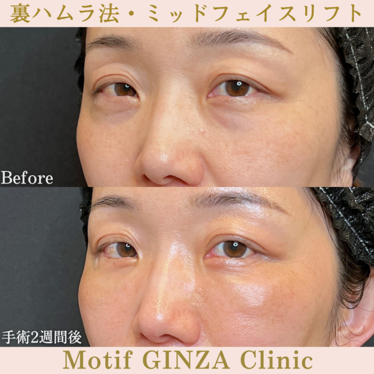裏ハムラ法・ミッドフェイスリフト(手術3か月)の写真6