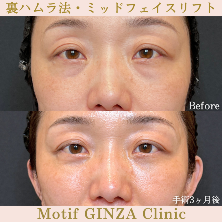 裏ハムラ法・ミッドフェイスリフト（手術３か月）