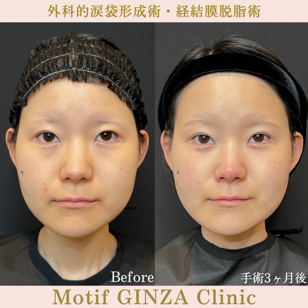外科的涙袋形成術・経結膜脱脂術（手術３か月）の写真