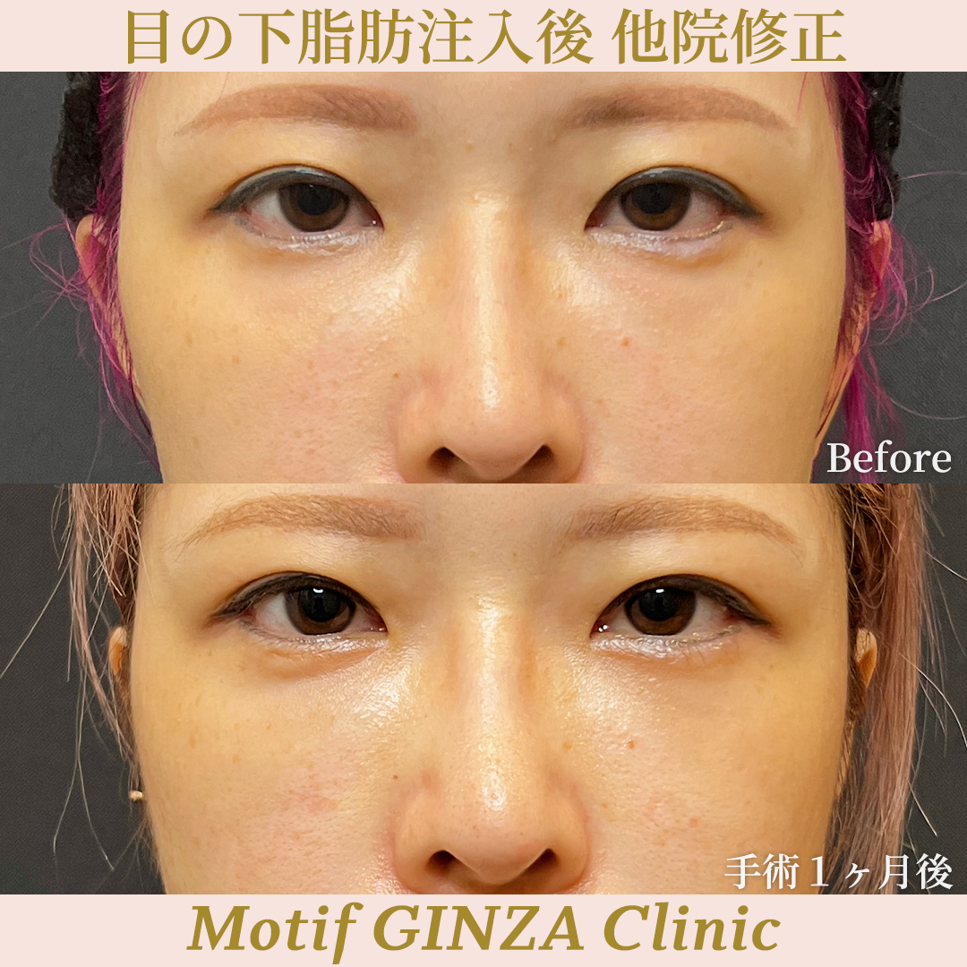 目の下脂肪注入後 他院修正（裏ハムラ法）（手術３ヶ月）の写真3