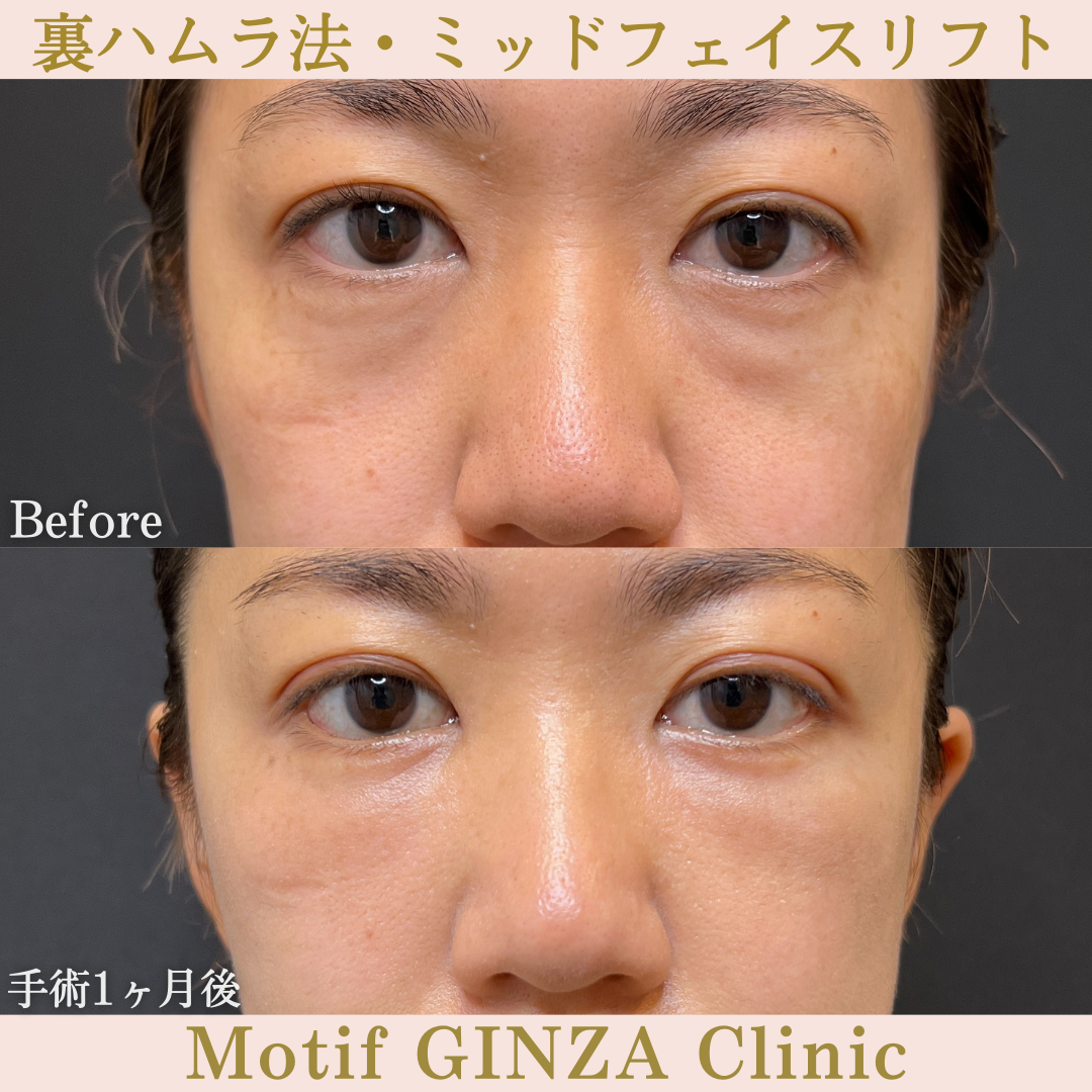 裏ハムラ法・ミッドフェイスリフト（手術１年１ヶ月）の写真3