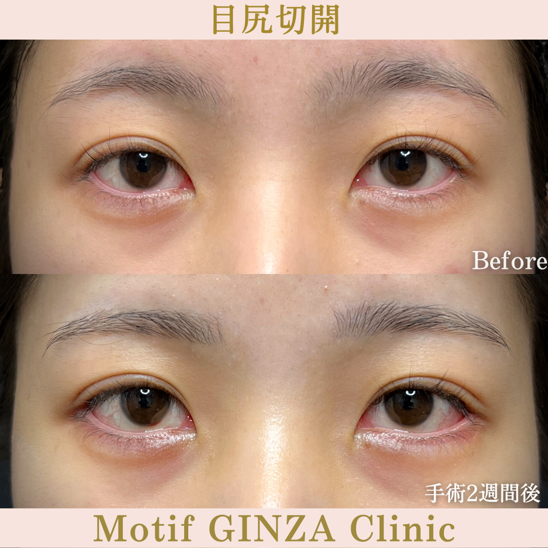 目尻切開手術（手術２週間）の写真