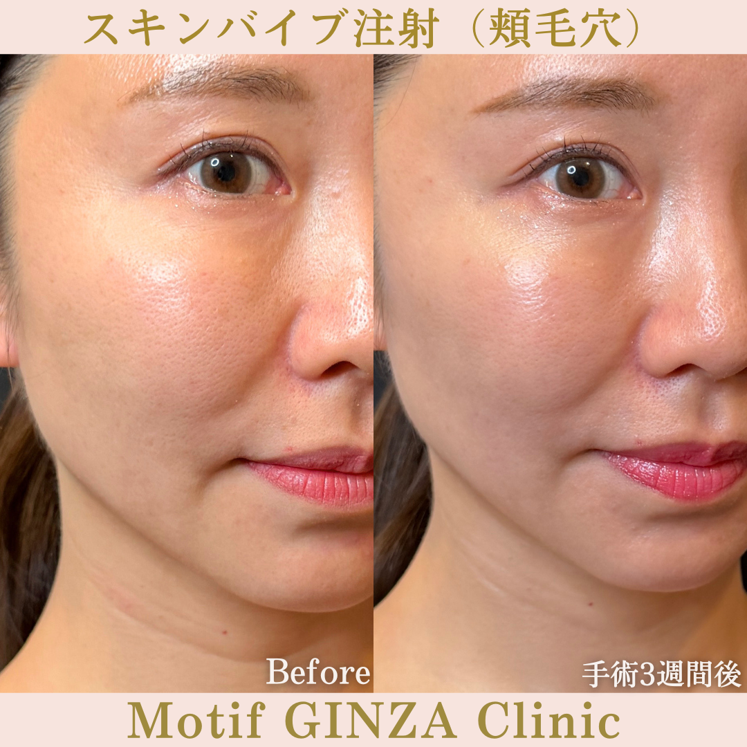 スキンバイブ注射（頬毛穴）（手術3週間）の写真