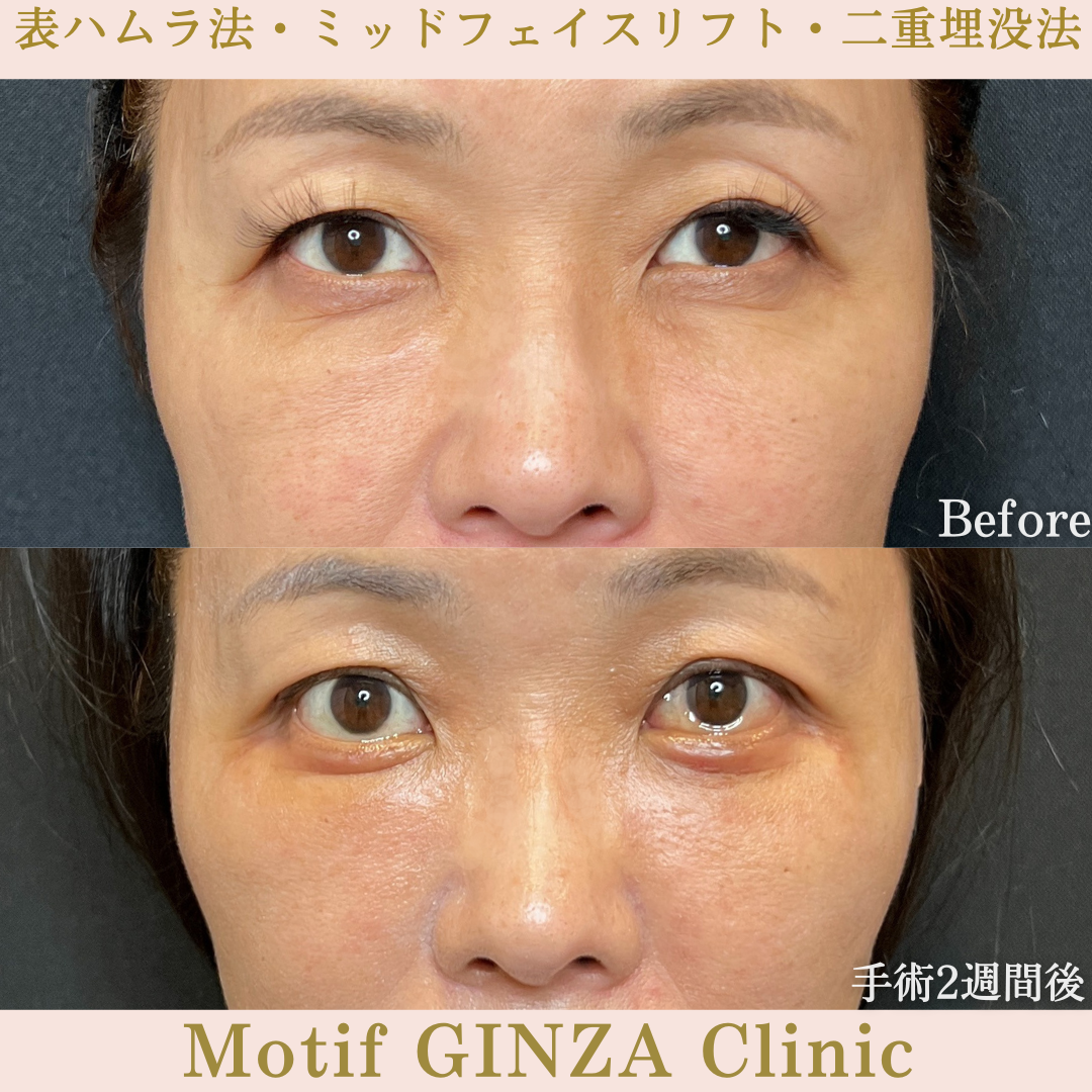 切開式下眼瞼たるみ取り・ミッドフェイスリフト・二重埋没法(手術6か月)の写真4