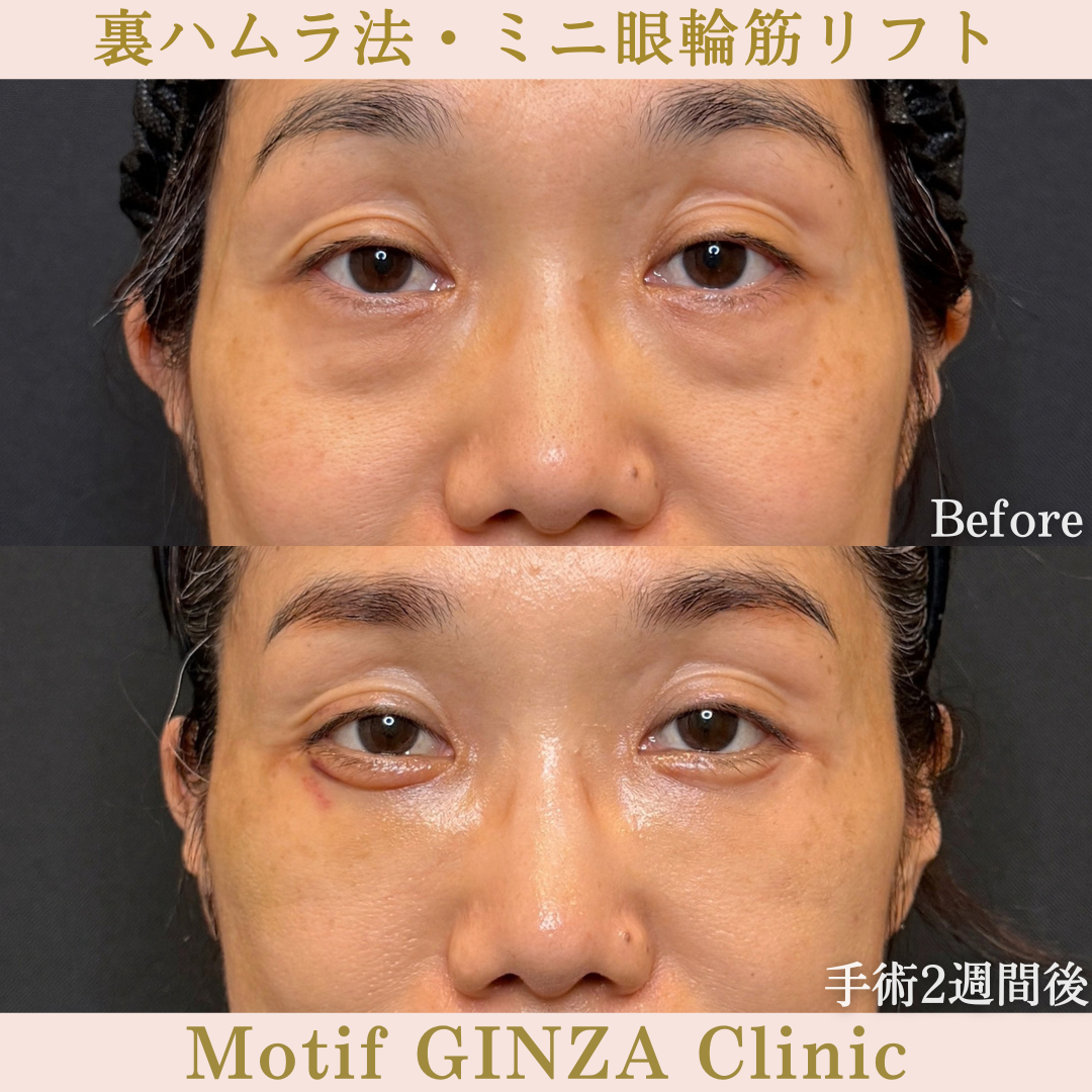 裏ハムラ法・ミニ眼輪筋リフト（手術３か月）の写真5