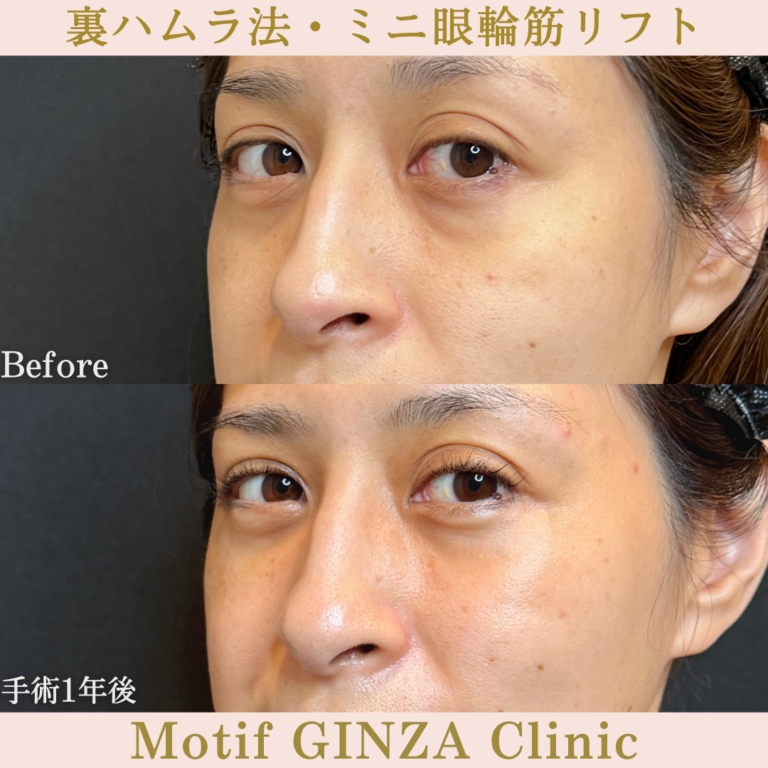 裏ハムラ法・ミニ眼輪筋リフト（手術1年）の写真3