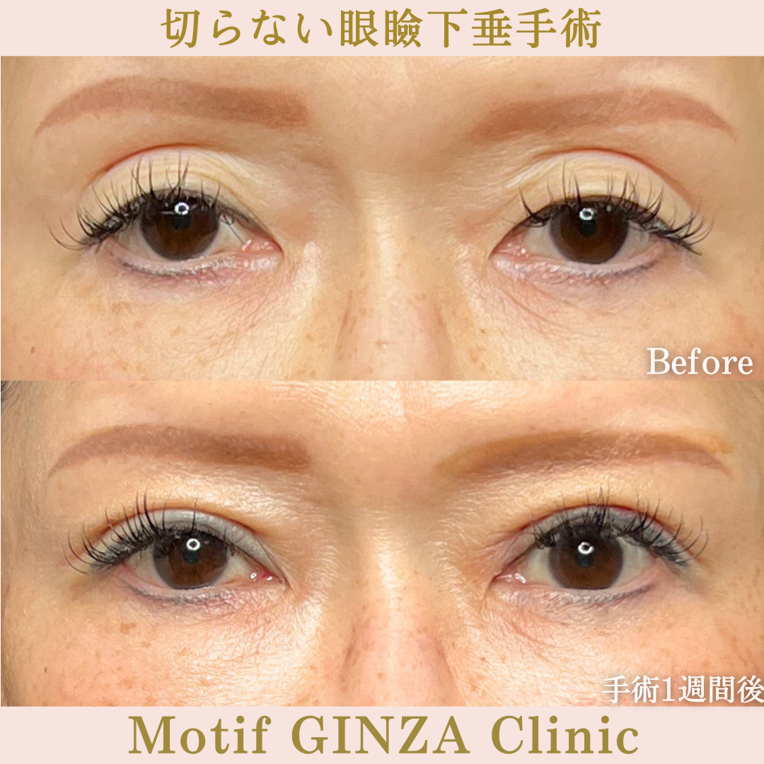 切らない眼瞼下垂手術(手術1か月)の写真2