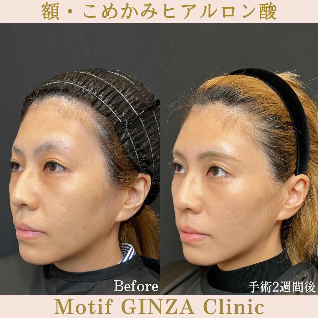 額・こめかみヒアルロン酸（手術2週間）の写真