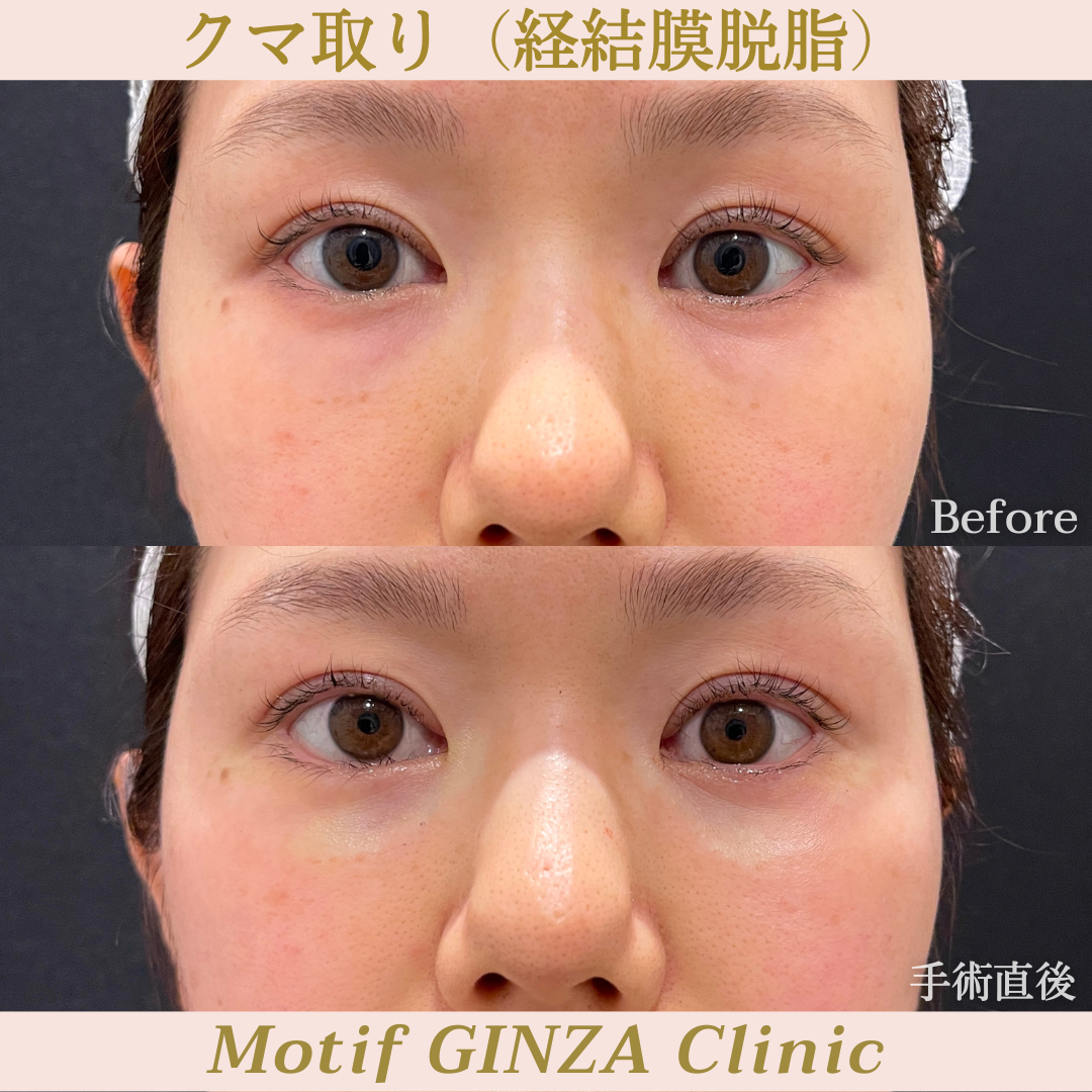 経結膜脱脂(手術1ヶ月)の写真4