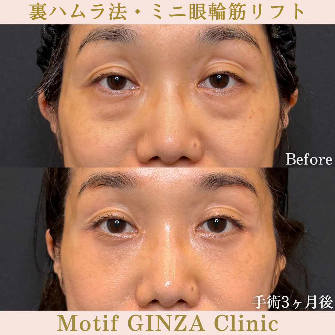 裏ハムラ法・ミニ眼輪筋リフト（手術３か月）の写真