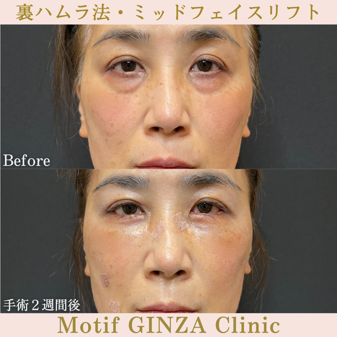 裏ハムラ法・ミッドフェイスリフト（手術3年7ヶ月）の写真6