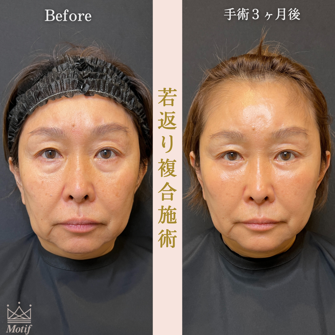 若返り複合施術（手術３ヶ月）の写真