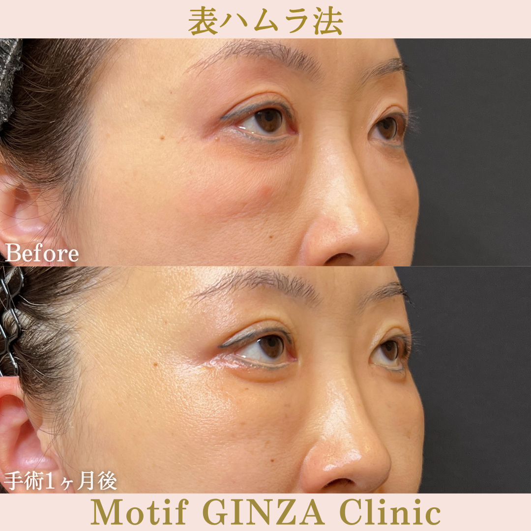 切開式下眼瞼たるみ取り(手術6ヶ月)の写真4