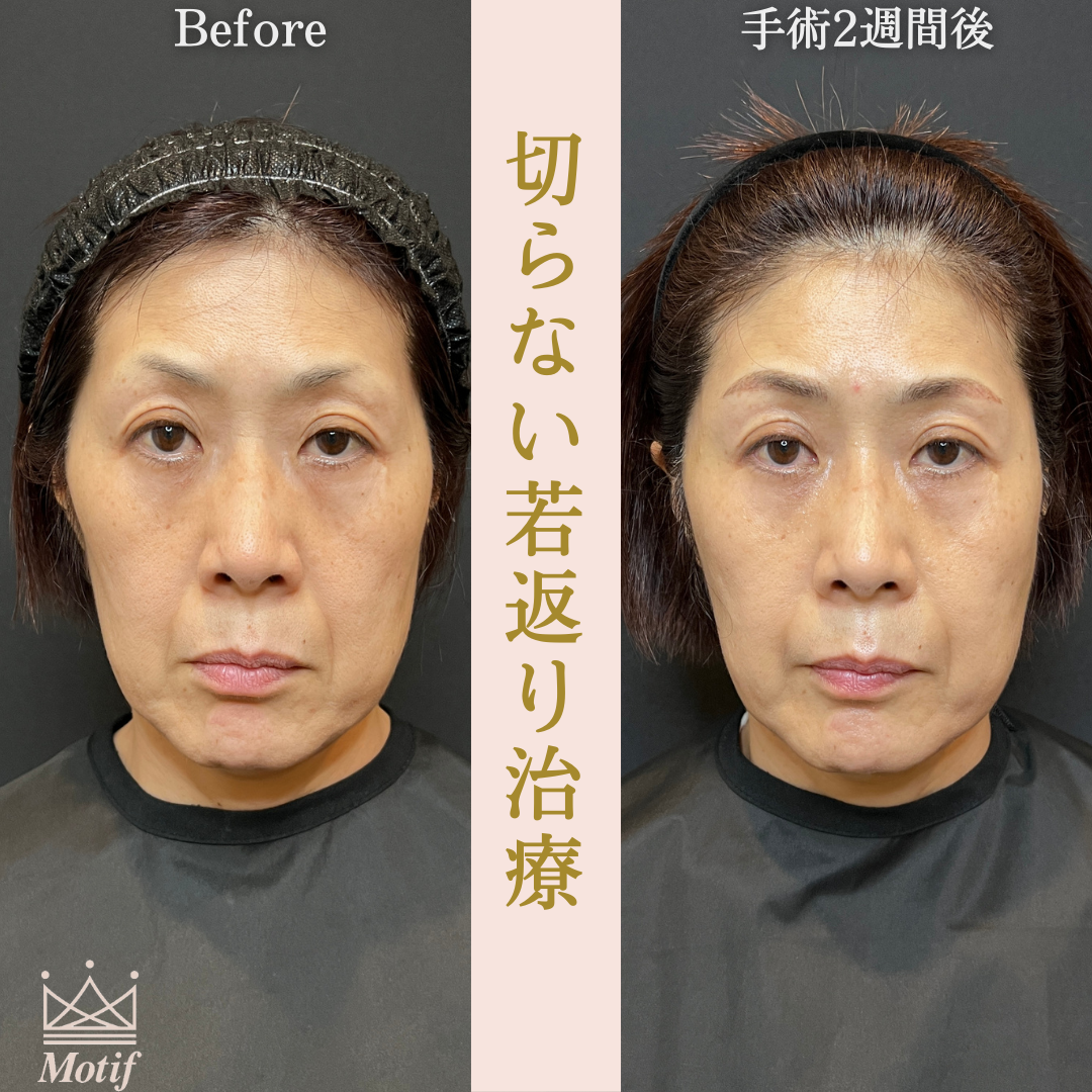 切らない若返り治療（手術１ヶ月）の写真4