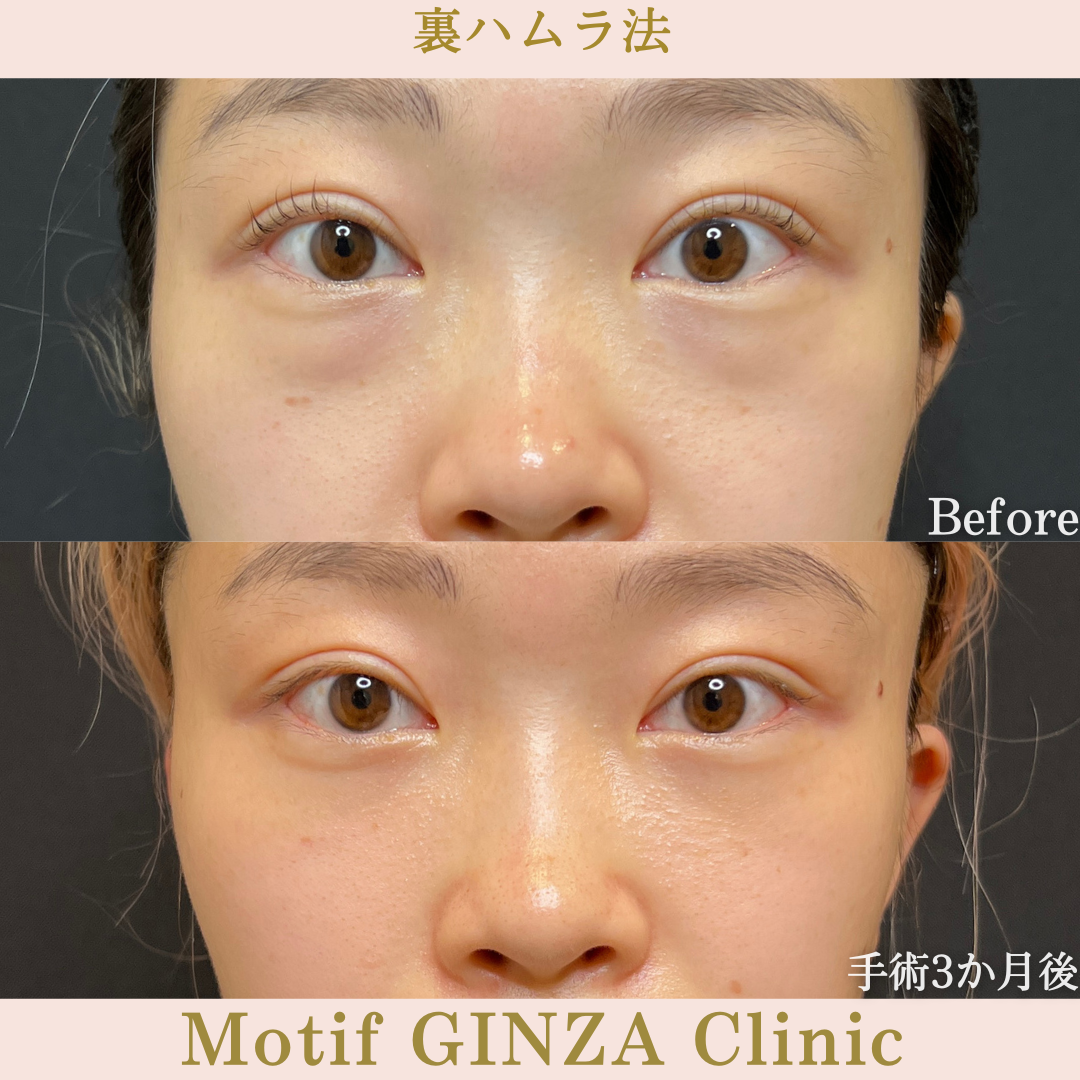 裏ハムラ法（手術１年９か月）の写真3