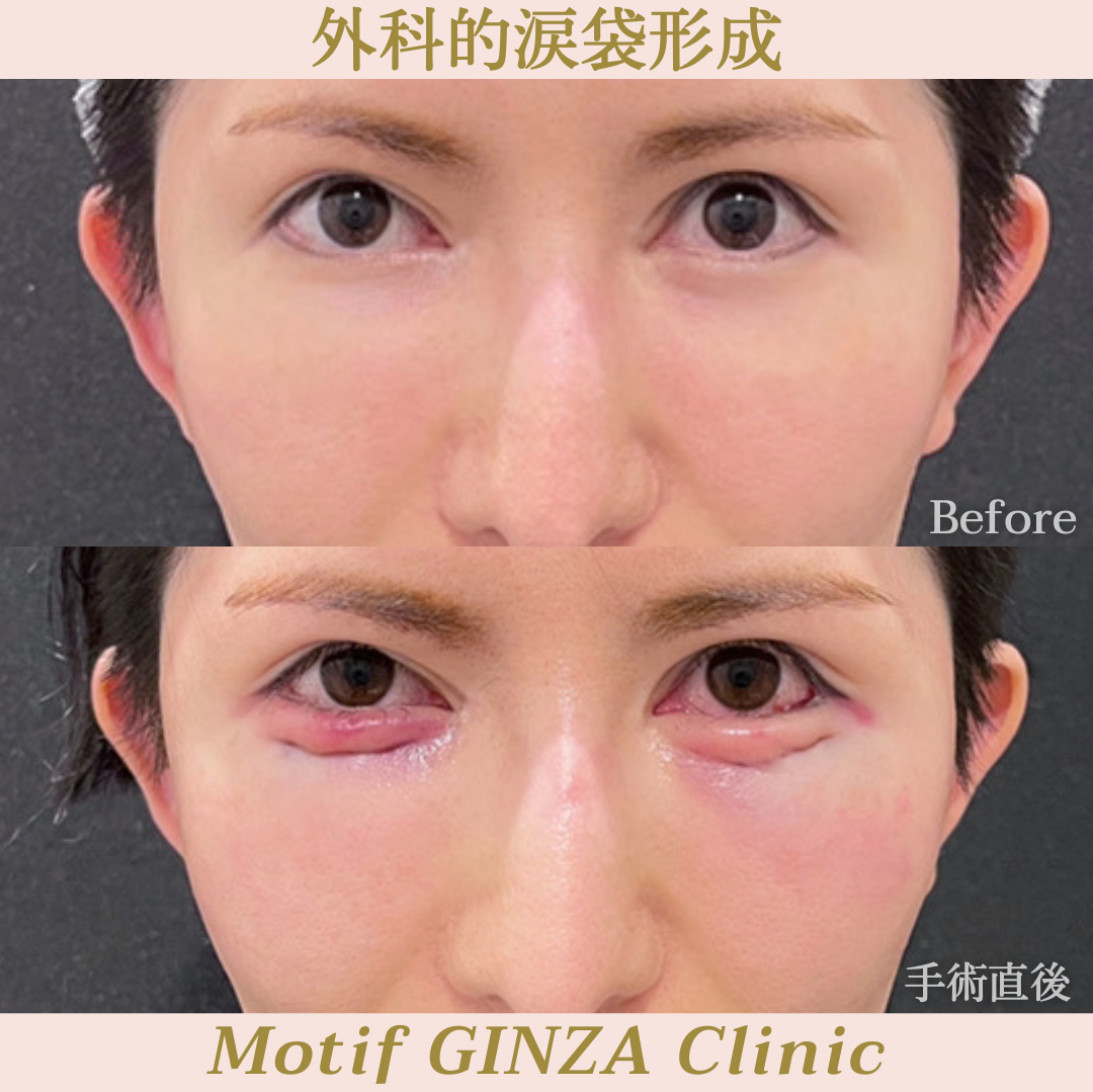 外科的涙袋形成(手術3ヶ月)の写真6