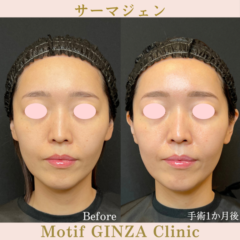 サーマジェン（手術1か月）