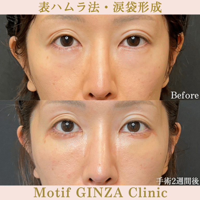 表ハムラ法・涙袋形成（手術３か月）の写真5