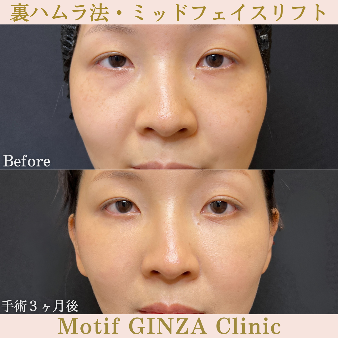 裏ハムラ法・ミッドフェイスリフト（手術３ヶ月）の写真