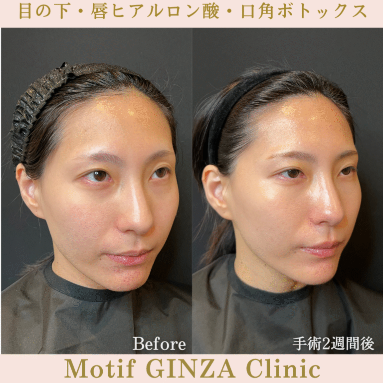 目の下・唇ヒアルロン酸・口角ボトックス（手術１か月後）の写真4