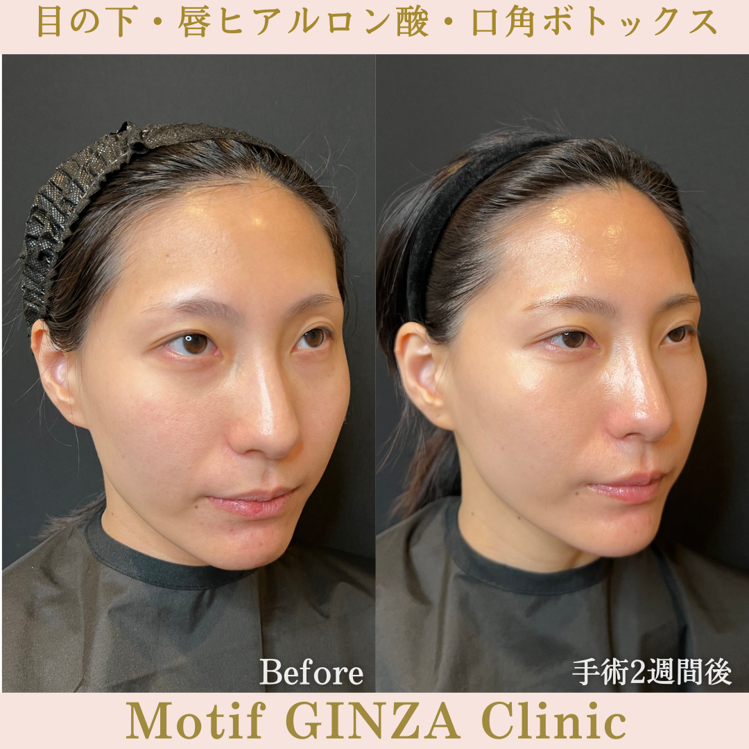 目の下・唇ヒアルロン酸・口角ボトックス（手術１か月）の写真4