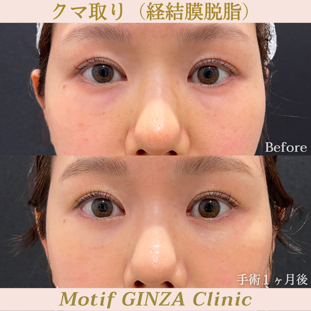 経結膜脱脂(手術1ヶ月)の写真1